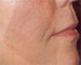 Dermal fillers - Photo before - NZOZ KRIOCENTRUM