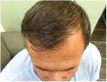 Haartransplantation - Vorher Foto - Prohaarklinik
