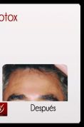 Botox/Dysport - Eliminar arrugas - Foto Antes de - Dr. Aristides Arellano-Huacuja