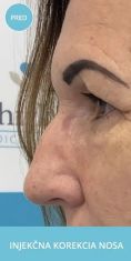 Radiesse (Calcium hydroxylapatit) - Nechirurgická metóda rhinoplastiky / korekcii nosa/ prebieha v lokálnom znecitlivení pri vedomí pacienta s pomocou kyseliny hyalurónovej.
Výplňový materiál kyselina hyalurónová sa injekčne aplikuje do oblasti nosa a koriguje vrodenú alebo získanú zmenu tvaru nosa.
Nos môže byť po aplikácií kyseliny rovnejší, súmernejší, bez jaziev po úraze.
Výsledný efekt je okamžitý.
Zákrok trvá 15 až 30 minút.
Účinok je od 6 mesiacov do 20 mesiacov.