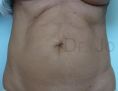 Abdominoplasty (Tummy Tucks) - Photo before - Dr. med. Jozefina Skulavik
