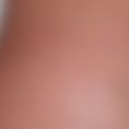 Breast Augmentation - Breast Implants - Age: 20 – 25 year old female. Photos taken 3 months post operation