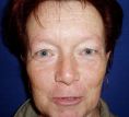 Eyelid surgery (Blepharoplasty) - Photo before - Klinika Laser Esthetic