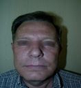Fotorejuvenecimiento (IPL) - rejuvenecimiento de la piel - Foto Antes de - Dr. Aristides Arellano-Huacuja
