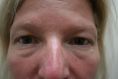 Eyelid surgery (Blepharoplasty) - Photo before - Dr. Nasim Huq M.S., FRCSC, M.Sc.,F.A.C.S. C.A.Q.S.H.