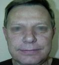 Fotorejuvenecimiento (IPL) - rejuvenecimiento de la piel - Foto Antes de - Dr. Aristides Arellano-Huacuja