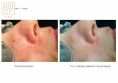 Spider veins laser removal (redness, birh marks) - Photo before - Bieńkowscy Clinic®