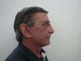 Liposucción - El siguiente paciente de 60 años de edad presenta una marcada caida de el tercio medio facial con exceso de piel en cuello ademas de blefarochalasis en ambos parpados tanto superior como inferior en la foto se visualiza el resultado de practicarse un estiramiento facial a las 3 semanas
