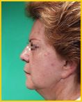 Fotorejuvenecimiento (IPL) - rejuvenecimiento de la piel - Foto Antes de - Dr. Aristides Arellano-Huacuja