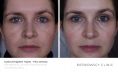 Age Spots Treatment - Photo before - Dr n. med. Marcin Bieńkowski