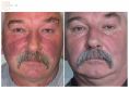 Spider veins laser removal (redness, birh marks) - Photo before - Bieńkowscy Clinic®