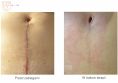 Laser Scar Treatment - Photo before - Dr n. med. Marcin Bieńkowski