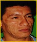 Fotorejuvenecimiento (IPL) - rejuvenecimiento de la piel - Foto Antes de - Dr. Aristides Arellano-Huacuja