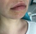 Injekčné výplne - Fotka pred - ENVY klinika estetickej medicíny