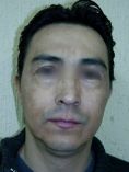 Fotorejuvenecimiento (IPL) - rejuvenecimiento de la piel - Foto Antes de - Dr. Aristides Arellano-Huacuja