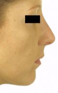 Rhinoplasty (Nose Job) - Photo before - Klinika Laser Esthetic