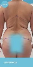 Liposukcia vodným lúčom (body-jet, Water-jet, WAL) - Fotka pred - Chirkoz Medical Clinic
