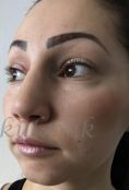 Septoplasty - Photo before - Dr. med. Jozefina Skulavik