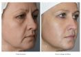 Fat (lipofiling) - Photo before - Dr n. med. Marcin Bieńkowski