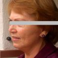 Facelift, SMAS Facelift - Vorher Foto - doc. MUDr. Jan Měšťák, CSc.