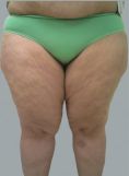 Liposukce - fotka před - OB Care