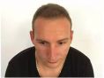 Haartransplantation - Vorher Foto - Prohaarklinik