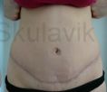 Abdominoplasty (Tummy Tucks) - Photo before - Dr. med. Jozefina Skulavik