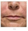 Nichtchirurgische Faltenbehandlung - BOTOX® / DYSPORT® - Vorher Foto - MUDr. Martin Molitor PhD.