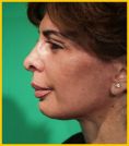 Fotorejuvenecimiento (IPL) - rejuvenecimiento de la piel - Foto Antes de - Dr. Aristides Arellano-Huacuja