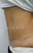 Abdominoplasty (Tummy Tucks) - Photo before - Dr. med. Jozefina Skulavik