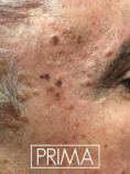 Asportazione nei, Rimozione nei - Foto del prima - Dott.ssa Marzia Bernardi