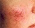 Spider veins laser removal (redness, birh marks) - Photo before - Klinika Laser Esthetic
