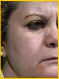Fotorejuvenecimiento (IPL) - rejuvenecimiento de la piel - Foto Antes de - Dr. Aristides Arellano-Huacuja