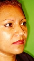 Fotorejuvenecimiento (IPL) - rejuvenecimiento de la piel - Foto Antes de - Dr. Aristides Arellano-Huacuja