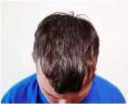 Haartransplantation - Vorher Foto - Prohaarklinik