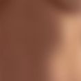 Breast Augmentation - Breast Implants - Age: 20 – 25 year old female. Photos taken 3 months post operation