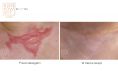 Laser Scar Treatment - Photo before - Dr n. med. Marcin Bieńkowski