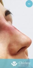 Radiesse (Calcium hydroxylapatit) - Fotka pred - Chirkoz Medical Clinic