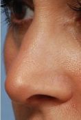 Nasenkorrektur - Rhinoplastik - Vorher Foto - MUDr. Martin Molitor PhD.