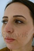 Septoplasty - Photo before - Dr. med. Jozefina Skulavik