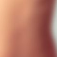 Breast Augmentation - Breast Implants - Age: 20 – 25 year old female. Photos taken 3 months post operation