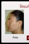 Rejuvenecimiento facial con láser fraccionado - Foto Antes de - Dr. Aristides Arellano-Huacuja