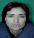 Fotorejuvenecimiento (IPL) - rejuvenecimiento de la piel - Foto Antes de - Dr. Aristides Arellano-Huacuja