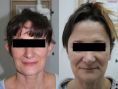 Ear surgery (Otoplasty) - Photo before - ARS ESTETICA – Klinika Medycyny Estetycznej i Laseroterapii