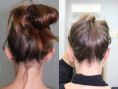 Ear surgery (Otoplasty) - Photo before - ARS ESTETICA – Klinika Medycyny Estetycznej i Laseroterapii
