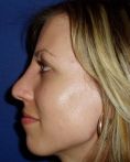 Rhinoplasty (Nose Job) - Photo before - Klinika Laser Esthetic