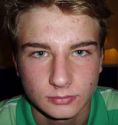 Laser acne treatment - Photo before - Klinika Laser Esthetic
