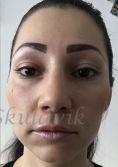 Septoplasty - Photo before - Dr. med. Jozefina Skulavik