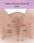 Labiaplasty (Labia Reduction) - Photo before - Dr Jayson Oates