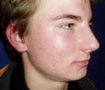 Laser acne treatment - Photo before - Klinika Laser Esthetic